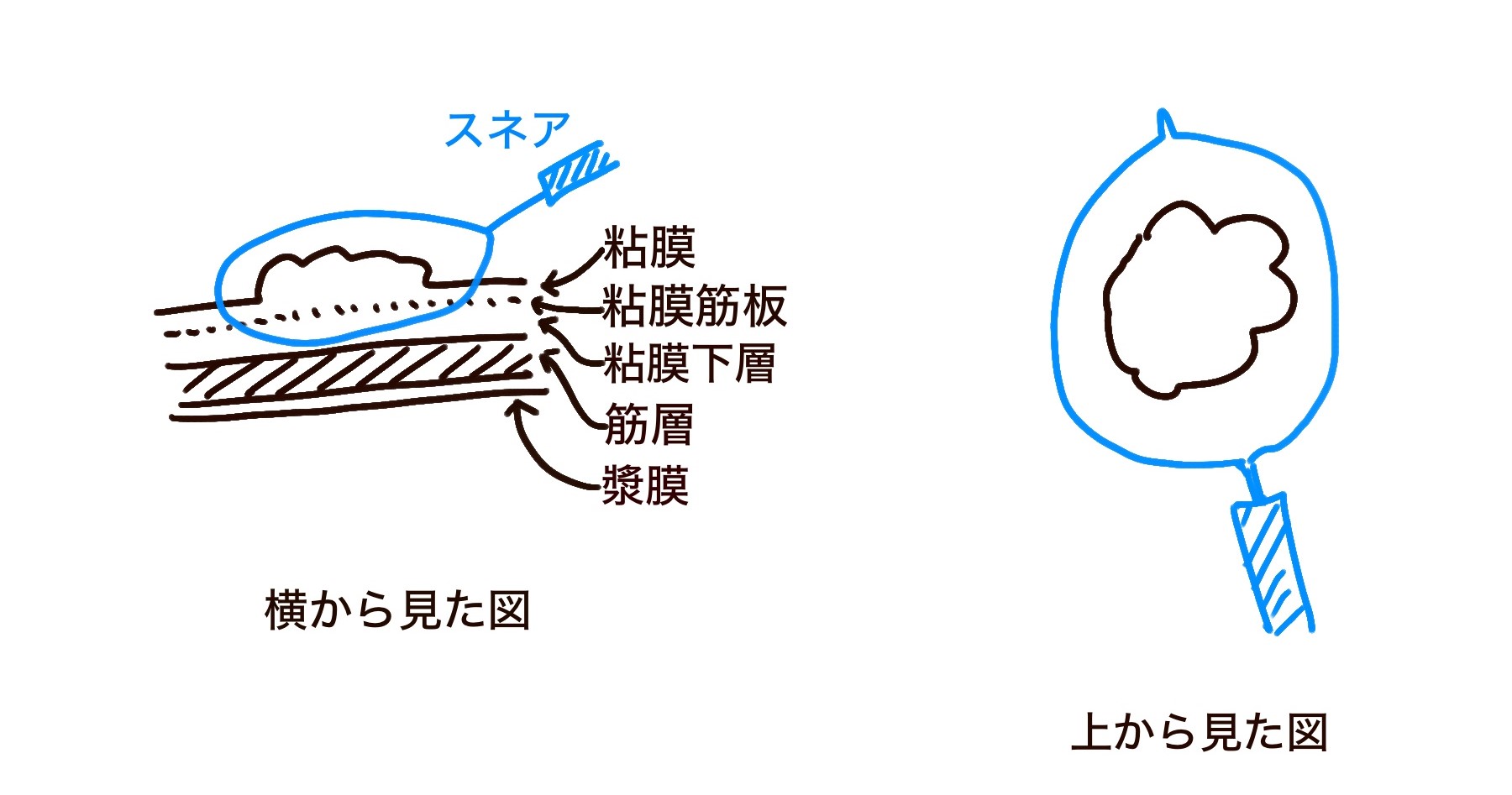 コールドポリペクトミーのコツ