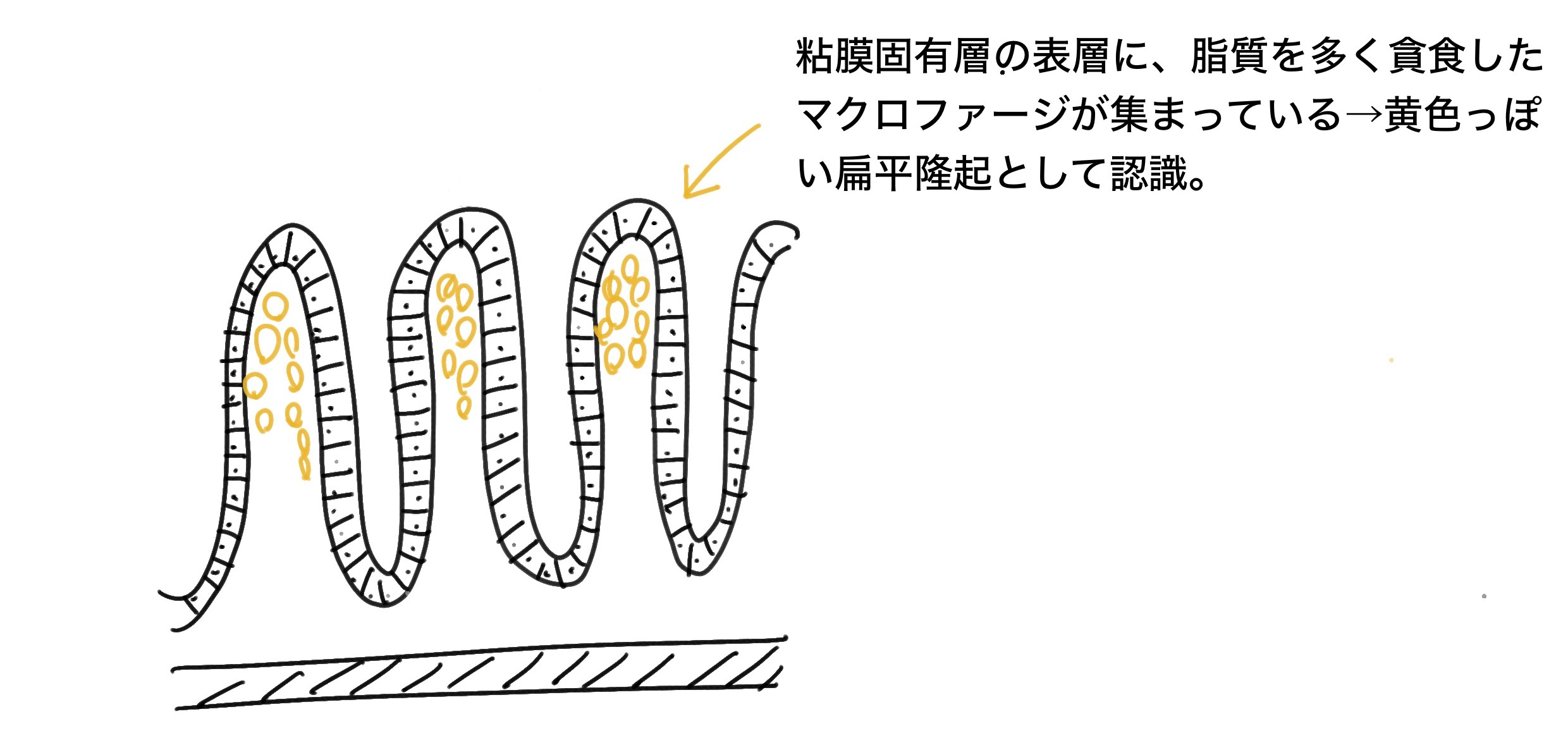 胃黄色腫(キサントーマ)