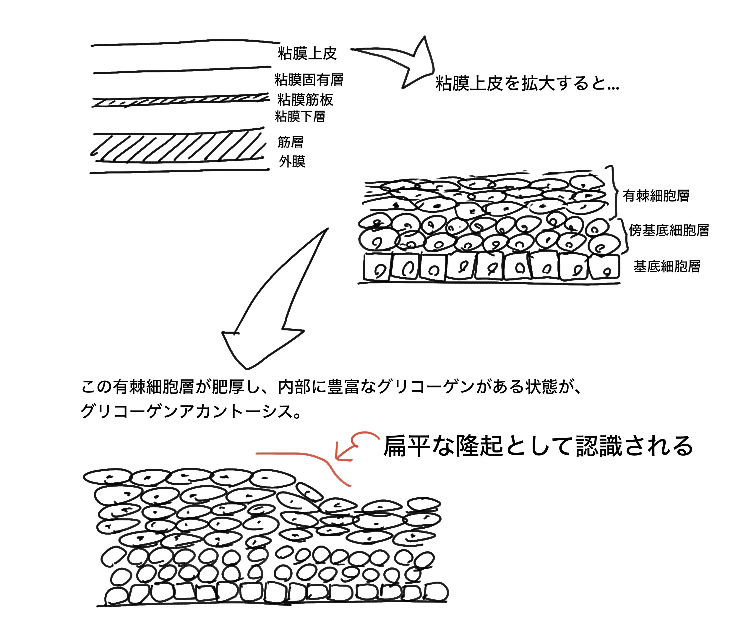 グリコーゲンアカントーシス